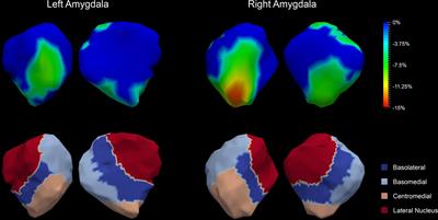 Amygdalar and Hippocampal Morphometry Abnormalities in First-Episode Schizophrenia Using Deformation-Based Shape Analysis